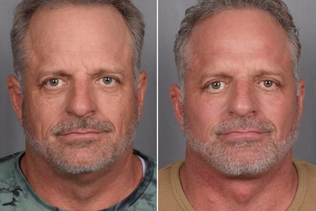 Facelift result at Vegas Facial Plastics in Las Vegas, NV