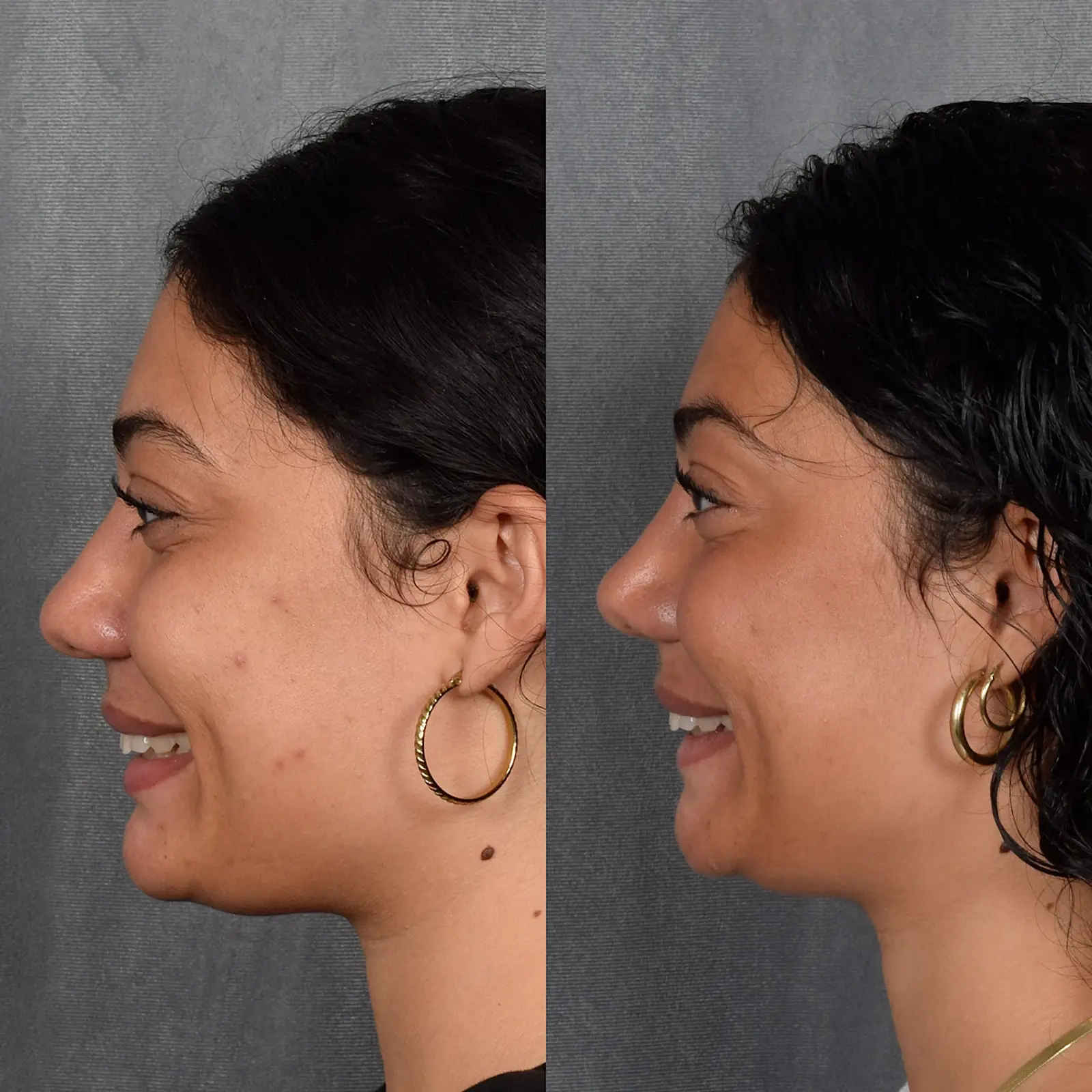 Vegas Facial Plastics rhinoplasty result — Las Vegas, NV