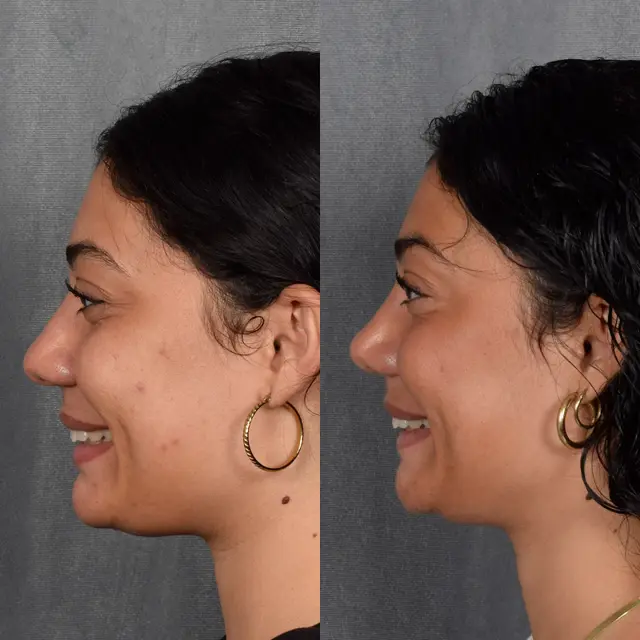 Functional Rhinoplasty result at Vegas Facial Plastics in Las Vegas, NV