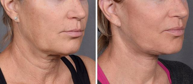 Neck Lift result at Vegas Facial Plastics in Las Vegas, NV