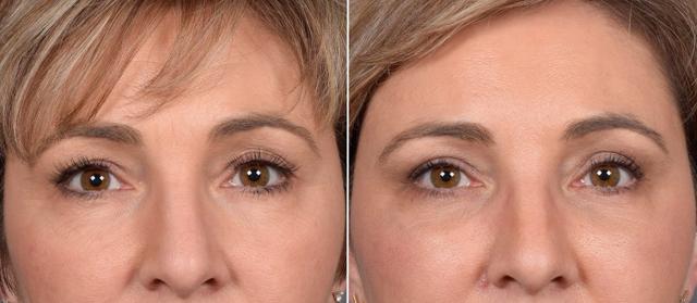 Blepharoplasty result at Vegas Facial Plastics in Las Vegas, NV