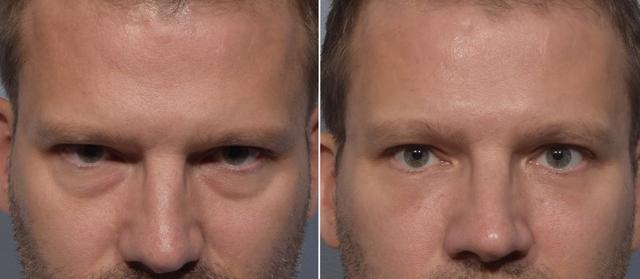 Blepharoplasty result at Vegas Facial Plastics in Las Vegas, NV