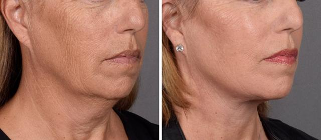 Neck Lift result at Vegas Facial Plastics in Las Vegas, NV
