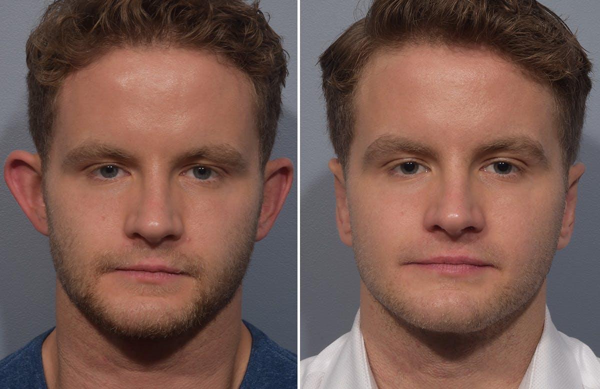 Vegas Facial Plastics otoplasty result — Las Vegas, NV