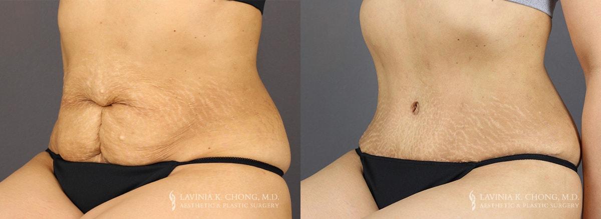 Dr. Lavinia K. Chong tummy tuck result — Newport Beach, CA