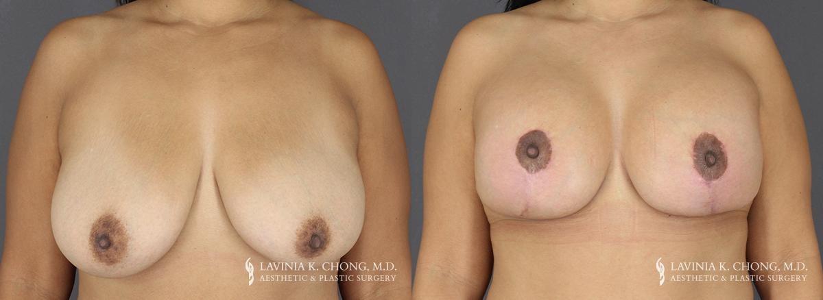 Dr. Lavinia K. Chong breast augmentation result — Newport Beach, CA
