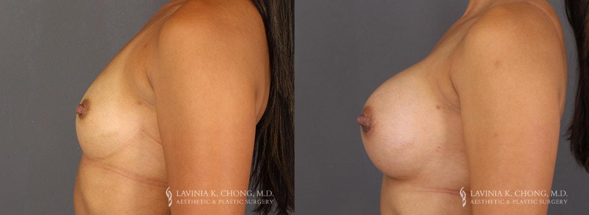Dr. Lavinia K. Chong breast augmentation result — Newport Beach, CA