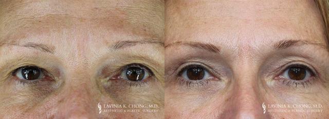 Blepharoplasty result at Dr. Lavinia K. Chong in Newport Beach, CA