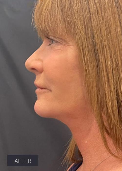 Dr. Lavinia K. Chong facelift after — Newport Beach, CA