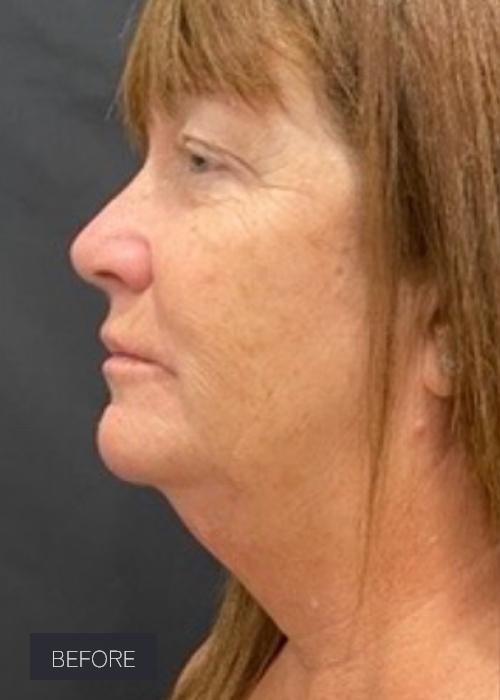 Facelift before at Dr. Lavinia K. Chong in Newport Beach, CA