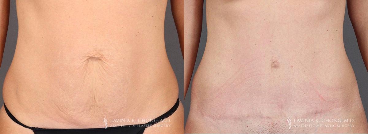 Dr. Lavinia K. Chong tummy tuck result — Newport Beach, CA