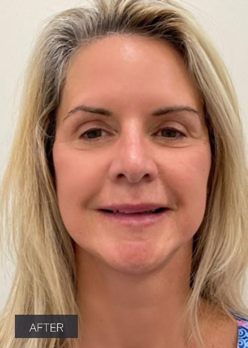 Dr. Lavinia K. Chong facelift after — Newport Beach, CA