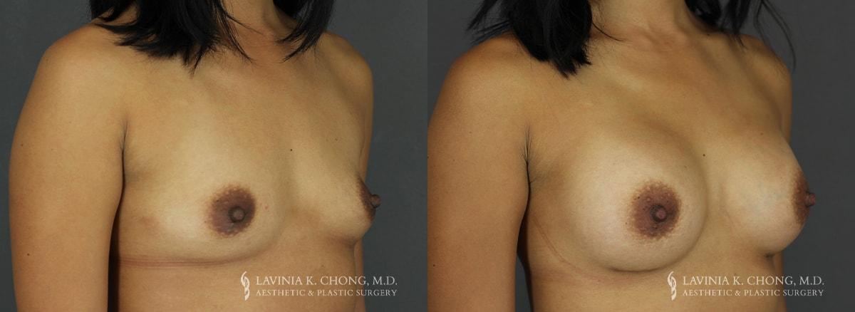 Dr. Lavinia K. Chong breast augmentation result — Newport Beach, CA