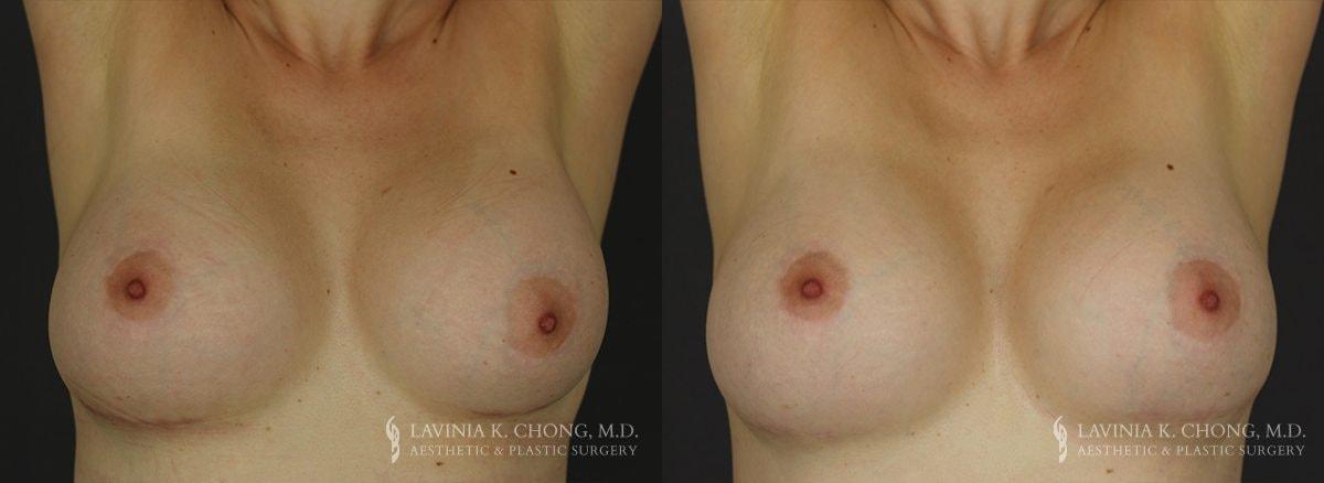 Dr. Lavinia K. Chong breast augmentation revision result — Newport Beach, CA