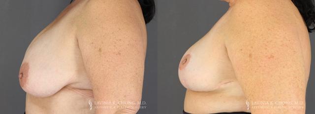 Breast Reduction result at Dr. Lavinia K. Chong in Newport Beach, CA