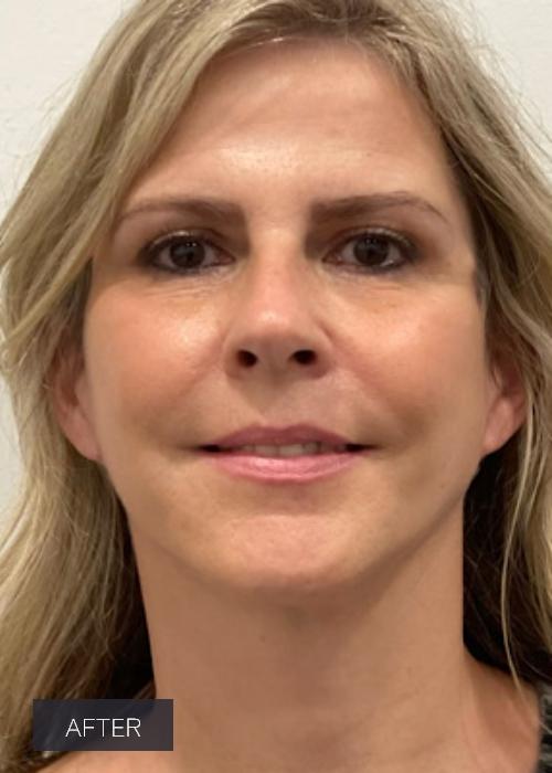 Dr. Lavinia K. Chong facelift after — Newport Beach, CA