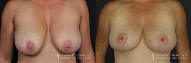 Breast Lift result at Dr. Lavinia K. Chong in Newport Beach, CA