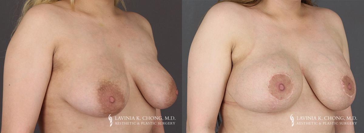 Dr. Lavinia K. Chong breast augmentation result — Newport Beach, CA