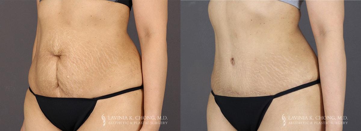 Dr. Lavinia K. Chong tummy tuck result — Newport Beach, CA