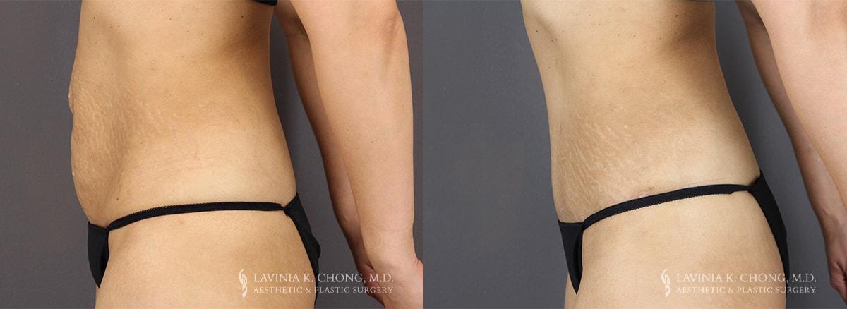 Dr. Lavinia K. Chong tummy tuck result — Newport Beach, CA