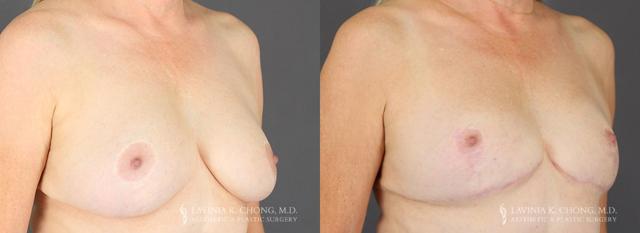 Breast Reduction result at Dr. Lavinia K. Chong in Newport Beach, CA