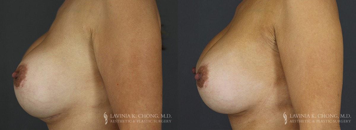 Dr. Lavinia K. Chong breast augmentation revision result — Newport Beach, CA