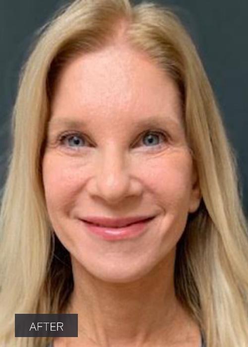 Dr. Lavinia K. Chong facelift after — Newport Beach, CA