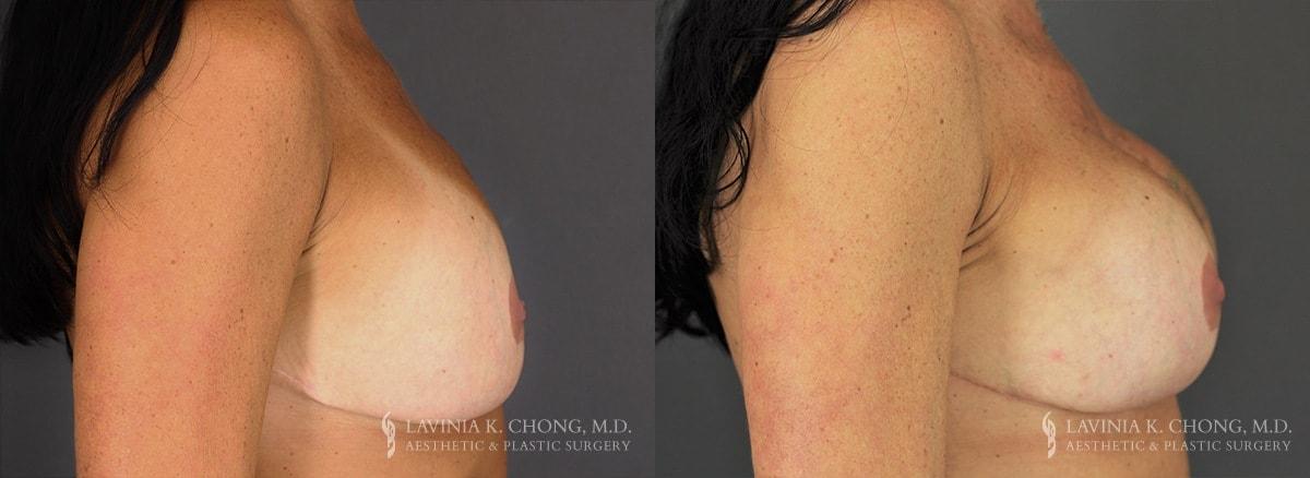Dr. Lavinia K. Chong breast augmentation revision result — Newport Beach, CA