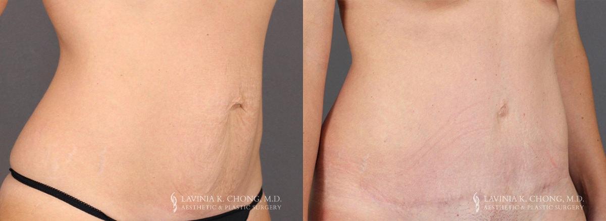 Dr. Lavinia K. Chong tummy tuck result — Newport Beach, CA