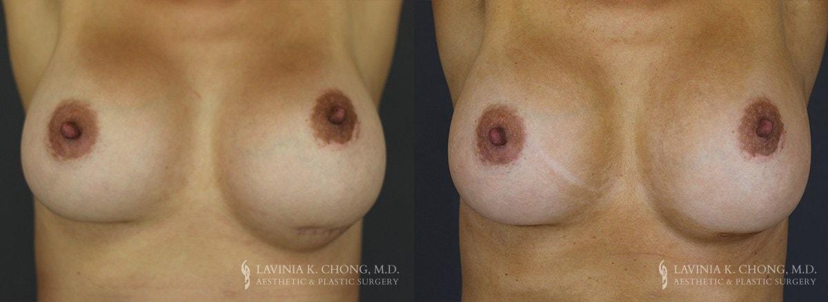 Dr. Lavinia K. Chong breast augmentation revision result — Newport Beach, CA