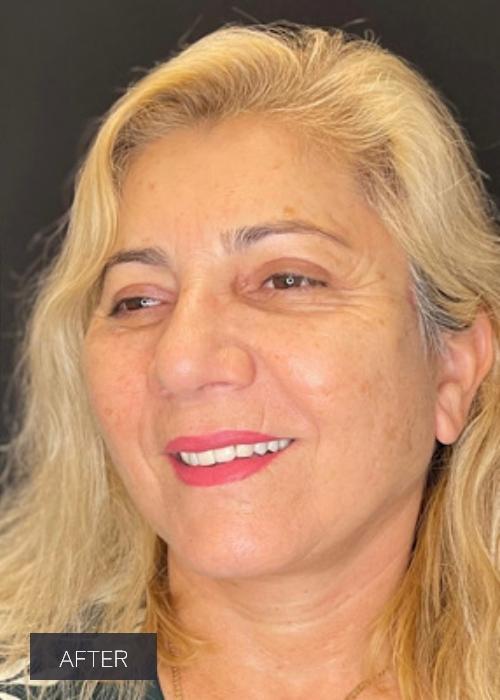 Dr. Lavinia K. Chong facelift after — Newport Beach, CA