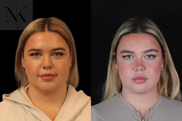 Neck Lift result at Karter Advanced Facial Plastic Surgery: Nicholas Karter, MD in Glastonbury, CT