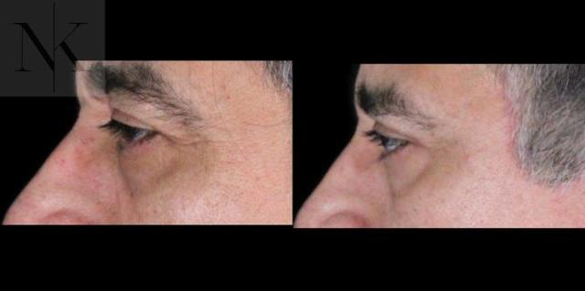 Blepharoplasty result at Karter Advanced Facial Plastic Surgery: Nicholas Karter, MD in Glastonbury, CT