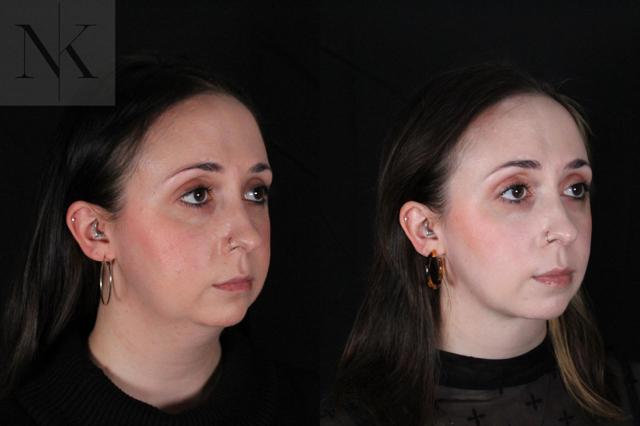 Neck Lift result at Karter Advanced Facial Plastic Surgery: Nicholas Karter, MD in Glastonbury, CT