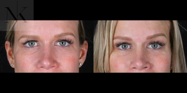Brow Lift result at Karter Advanced Facial Plastic Surgery: Nicholas Karter, MD in Glastonbury, CT