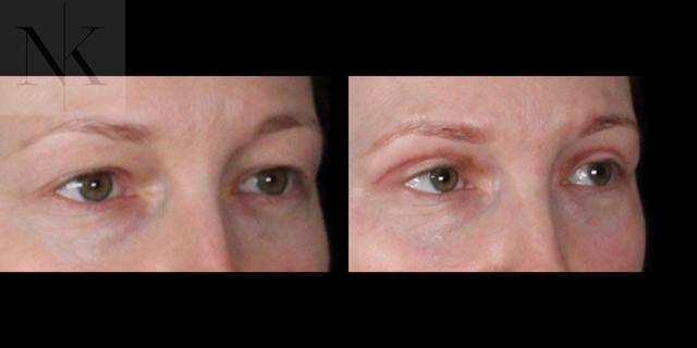 Blepharoplasty result at Karter Advanced Facial Plastic Surgery: Nicholas Karter, MD in Glastonbury, CT