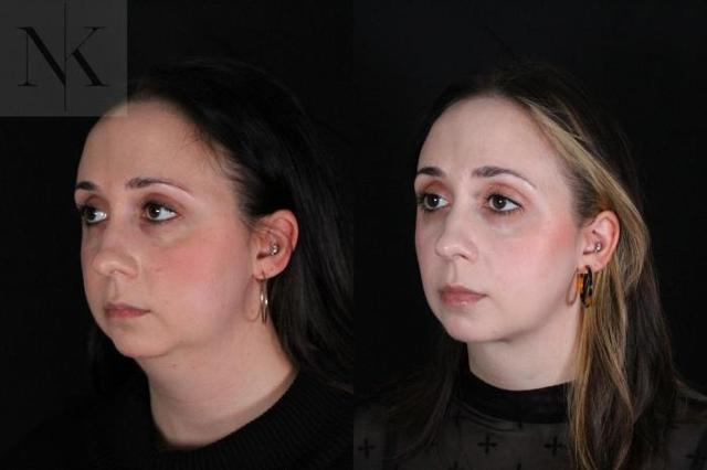 Neck Lift result at Karter Advanced Facial Plastic Surgery: Nicholas Karter, MD in Glastonbury, CT