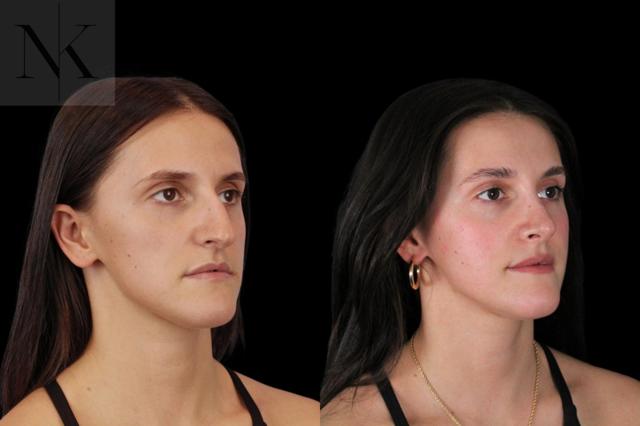 Rhinoplasty result at Karter Advanced Facial Plastic Surgery: Nicholas Karter, MD in Glastonbury, CT