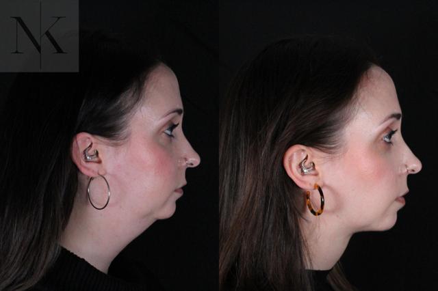 Neck Lift result at Karter Advanced Facial Plastic Surgery: Nicholas Karter, MD in Glastonbury, CT