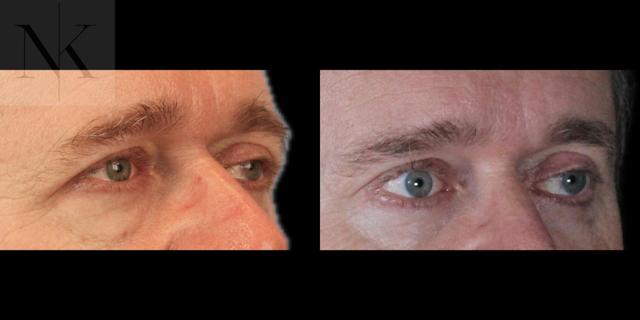 Brow Lift result at Karter Advanced Facial Plastic Surgery: Nicholas Karter, MD in Glastonbury, CT
