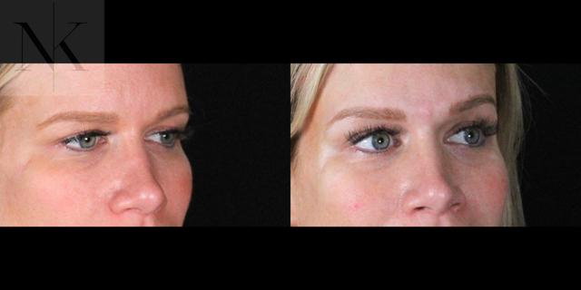 Brow Lift result at Karter Advanced Facial Plastic Surgery: Nicholas Karter, MD in Glastonbury, CT