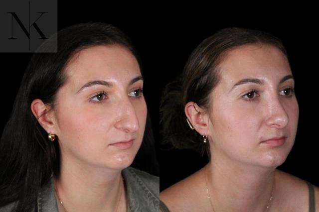 Rhinoplasty result at Karter Advanced Facial Plastic Surgery: Nicholas Karter, MD in Glastonbury, CT