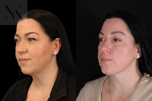 Neck Lift result at Karter Advanced Facial Plastic Surgery: Nicholas Karter, MD in Glastonbury, CT