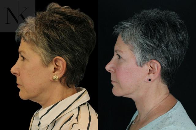 Facelift result at Karter Advanced Facial Plastic Surgery: Nicholas Karter, MD in Glastonbury, CT