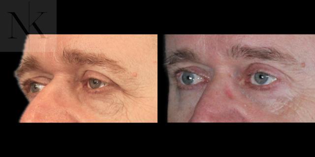 Brow Lift result at Karter Advanced Facial Plastic Surgery: Nicholas Karter, MD in Glastonbury, CT