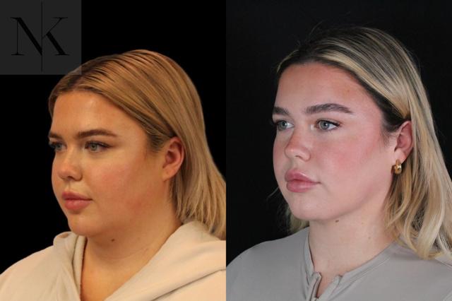 Neck Lift result at Karter Advanced Facial Plastic Surgery: Nicholas Karter, MD in Glastonbury, CT