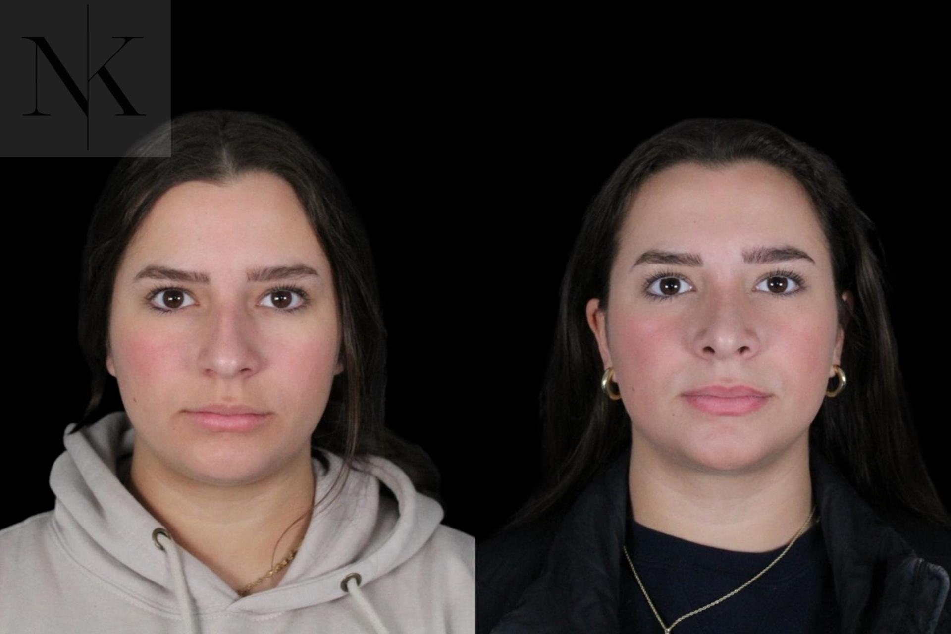 Karter Advanced Facial Plastic Surgery: Nicholas Karter, MD rhinoplasty result — Glastonbury, CT