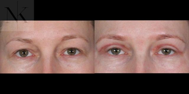 Blepharoplasty result at Karter Advanced Facial Plastic Surgery: Nicholas Karter, MD in Glastonbury, CT