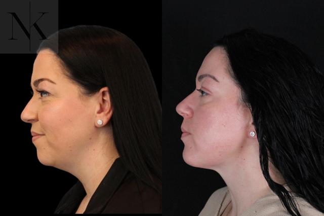 Neck Lift result at Karter Advanced Facial Plastic Surgery: Nicholas Karter, MD in Glastonbury, CT