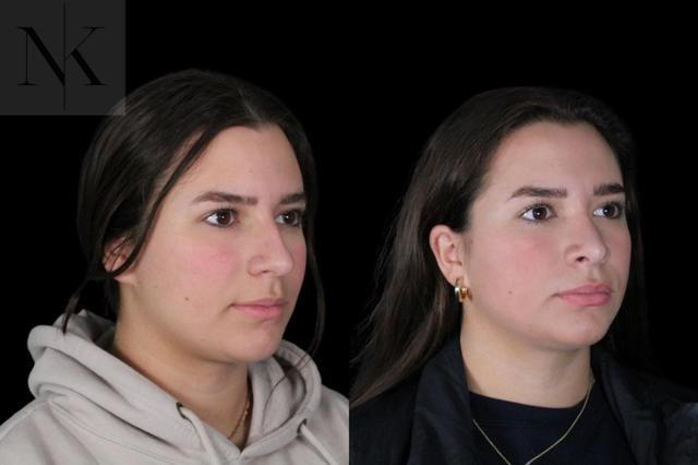 Rhinoplasty result at Karter Advanced Facial Plastic Surgery: Nicholas Karter, MD in Glastonbury, CT